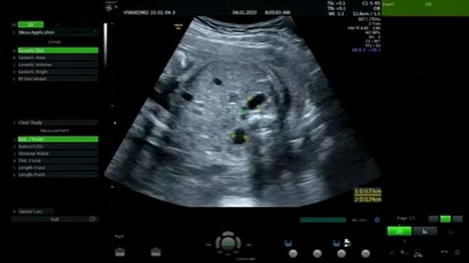 Fetal Hydronephrosis Ultrasound