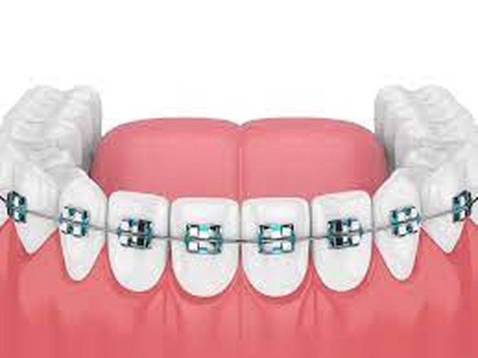 "Dental Braces: Straighten and Shine"