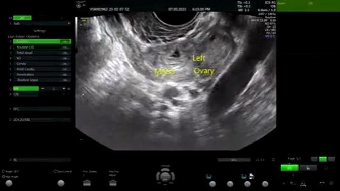  Grossesse extra-utérine ( GEU ) Ultrasound