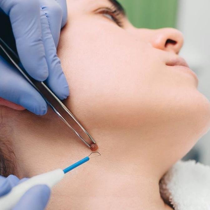 The Art of Mole Removal in Dubai