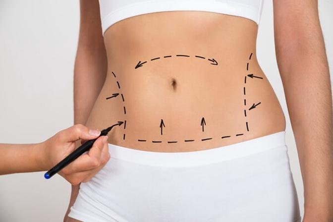 Understanding Liposuction: The Procedure and Its Purpose