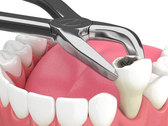 What are the Reason when Slow Down Bone Loss After Tooth Extraction