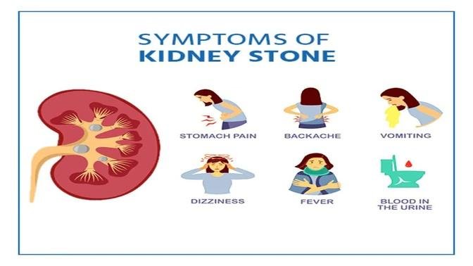 Kidney Stones (Nephrolithiasis) Signs & Symptoms | & Why They Occur