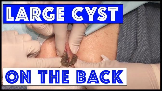 Large Epidermoid Cyst Excised on the Back