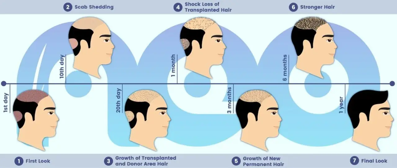 The Benefits of Hair Replacement in Turkey: A Guide to Effective Solutions for Hair Loss