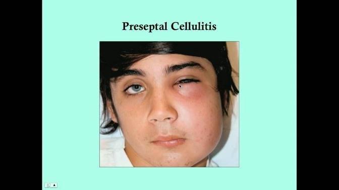 Preseptal and Orbital Cellulitis - CRASH! Medical Review Series