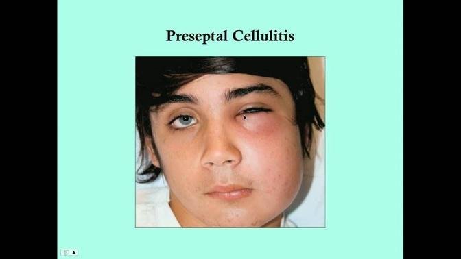 Preseptal And Orbital Cellulitis Crash Medical Review Series