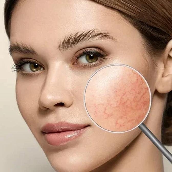 Personalized Rosacea Care: Dubai's Specialized Services?