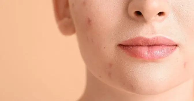 Beyond the Creams: Alternative Acne Treatments You Should Try