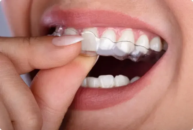 The Advantages of Invisible Aligners for Dubai Professionals