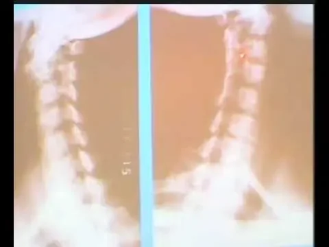 12椎动脉型颈椎病的探讨孙树椿02