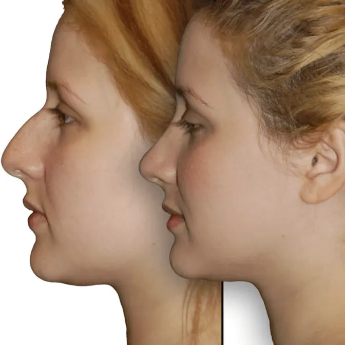 Understanding the Cost of Rhinoplasty in Beverly Hills