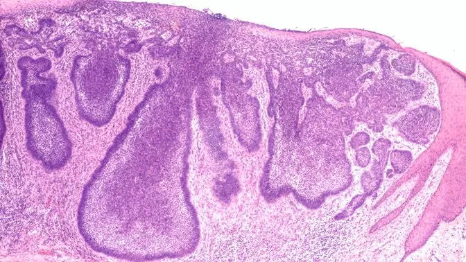 Differentiating Between Squamous and Basal Cell Carcinoma?